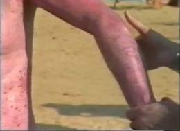 Psoriasis Patient Receiving Treatment at Dead Sea Medical Center